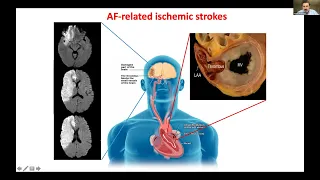 WSA Webinar - Cerebral Amyloid Angiopathy, ICH and Afib: Stroke Prevention Approaches