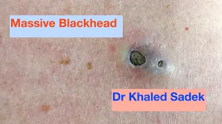Massive 3 year old Blackhead finally comes out. Dr Khaled Sadek. LipomaCyst.com