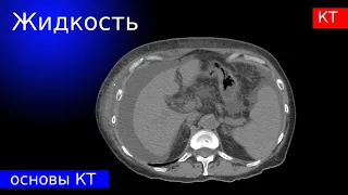 Лучевая диагностика | Жидкость на КТ : асцит, плеврит, кисты, ранулы