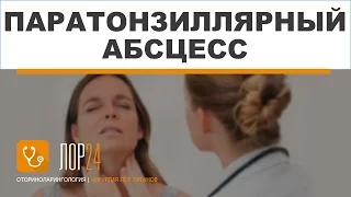 Паратонзиллярный абсцесс