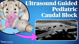 Ultrasound-Guided Pediatric Caudal Block
