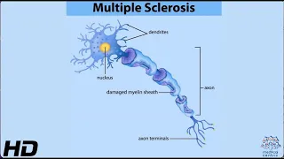 MULTIPLE SCLEROSIS: Everything You Need To Know