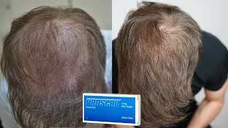 My Finasteride Results After 1 Year
