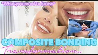 COMPOSITE BONDING, EVERYTHING YOU NEED TO KNOW! | AMY COOMBES