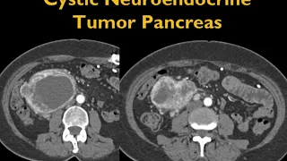 CT of Calcified Pancreatic Masses: What are they and why?