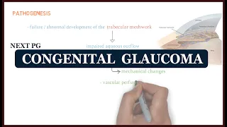 Congenital Glaucoma | ophthalmology | NEXT PG