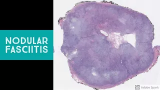 Nodular Fasciitis - Explained by a Soft Tissue Pathologist