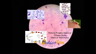 Peripheral Smear | Plasmodium falciparum | Thick and Thin Blood Smear | Giemsa Stain | Malaria