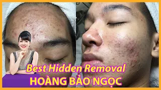 Best Video Hidden Removal | Điều trị mụn hiệu quả | Hiền Vân Spa | Hoàng Bảo Ngọc| part 1 552