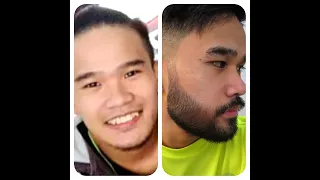 Minoxidil Beard Journey in 3 months(Intro)