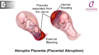 How can Multiple Pregnancy affect the risk of Pre eclampsia? I Dr. Shobha Venkat, Cloudnine Hospital