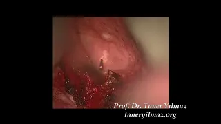 Endoscopic Zenker diverticulostomy with carbondioxide laser, MB, with name tag