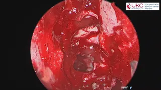 Transnasal Endoscopic Removal of the Intraconal Cavernoma