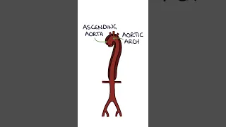 Aortic Dissection #medicine #vascularsurgery