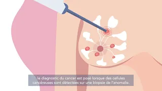 Le cancer du sein