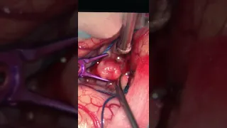 Aneurysm Clipping