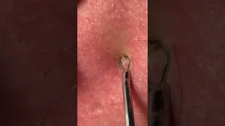 Blackhead Extraction 2021