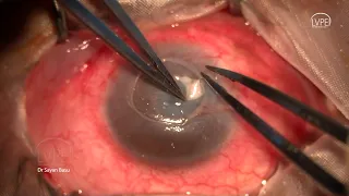 TeAM: a novel sutureless technique for managing corneal perforations
