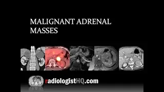 Malignant Adrenal Masses