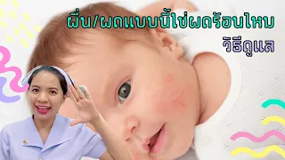 ผื่น/ผดแบบนี้ใช้ผดร้อนไหม วิธีดูแล