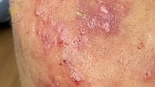 SAC DEP SPA Blackheads | #744