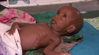 East Africa's tiny children starving to death