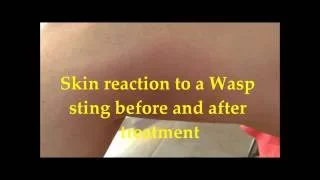 Effect of a wasp sting on the skin before and 48 hours after treatment