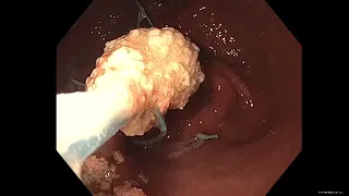 Endoscopic revision of gastric bypass using plication technique: an adjustable approach