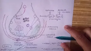 Pathophysiology  of Coronavirus