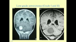 Tumors of the Central Nervous System - CRASH! Medical Review Series