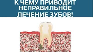 Осложнения после лечения пульпита. Плохо запломбированный канал зуба