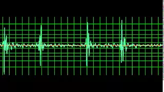 Prosthetic Mitral Valve Closing Click- slow