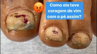 CLIENTE VEIO COM O PÉ PODRE E OLHA SÓ O QUE FIZ😡 Nail transformation