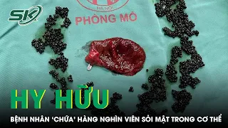 Hy Hữu: Bệnh Nhân 'Chứa' Hàng Nghìn Viên Sỏi Mật Trong Cơ Thể | SKĐS