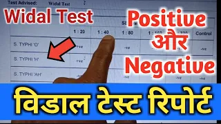 Widal Test, Widal Test Positive, Widal Test In Hindi, Widal Test Report, विडाल टेस्ट,Widaltestkaise