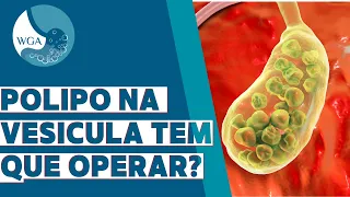 Precisa operar pólipo na vesícula?