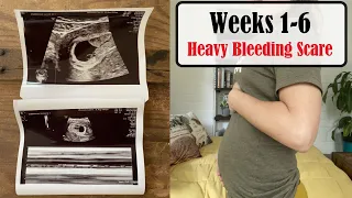 I'm PREGNANT! // Scary 1st Trimester Bleeding - SUBCHORIONIC HEMATOMA