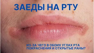 ★ Заеды на рту. Из-за чего в обоих углах рта покраснения и открытые раны?