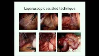 Impact of Laparoscopy on Outcome for Crohn�s Disease: Andre D�hoore, M.D.