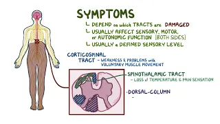 Transverse Myelitis | Osmosis