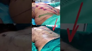 | How Dr. Amit Gupta Design Six Pack Abs | Plastic Surgeon in Delhi