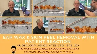 EAR WAX & SKIN PEEL REMOVAL WITH PATIENT REACTION - EP 224