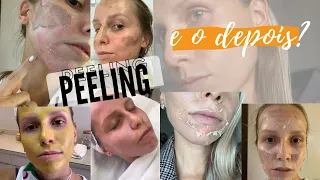 PEELING ANTES E DEPOIS - Bruna Harmel