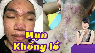 Điều trị mụn bọc, mụn viêm nang hiệu quả nhất TPHCM |Hiền Vân spa| Xuân Thắng | 591