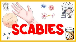 Scabies :- Life Cycle, Pathogenesis, Types, Signs & Symptoms, Risk Factors, Diagnosis & Treatment