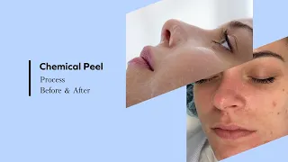 Chemical Peel Experience | BEFORE & AFTER - Full Process and Result - Facial Treatment 2021