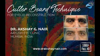 Eyelid Reconstruction - Cutler Beard Flap following tumour excision by Dr Akshay Nair (HD Video)