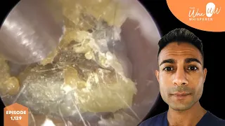 1,129 - Very Dry Itchy Dead Skin & Ear Wax Removal