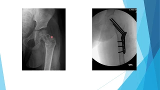 Pediatric Trauma (1): Lower Extremity