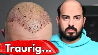 Schlimmstes Haartransplantation Ergebnis | mit Nachher Fotos